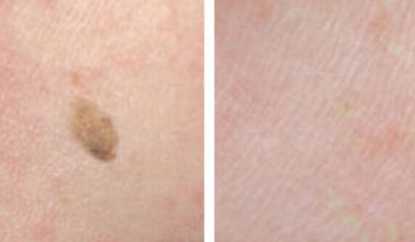 Close-up of Cryopen therapy being performed to treat skin lesions at Sydney Permanent Makeup Centre