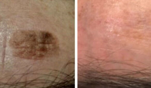 Cryotherapy skin tag removal using Cryopen device at Sydney Permanent Makeup Centre