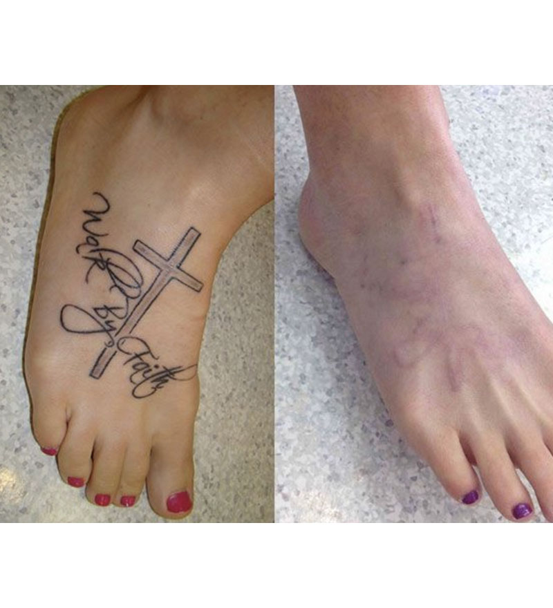 Laser Tattoo Removal