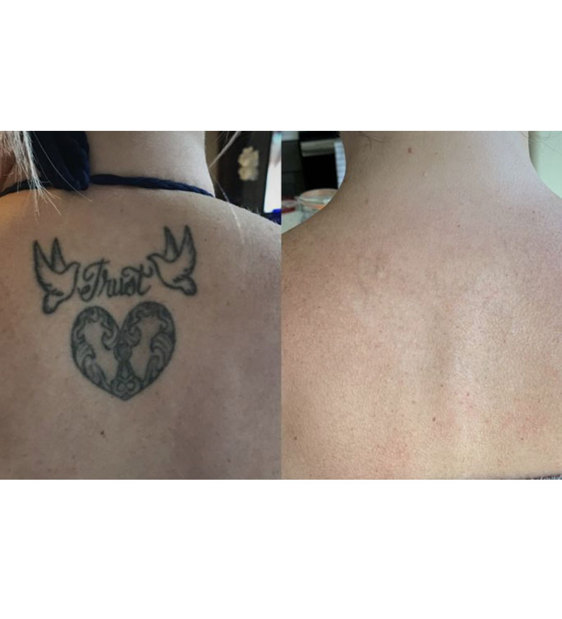 Laser Tattoo Removal