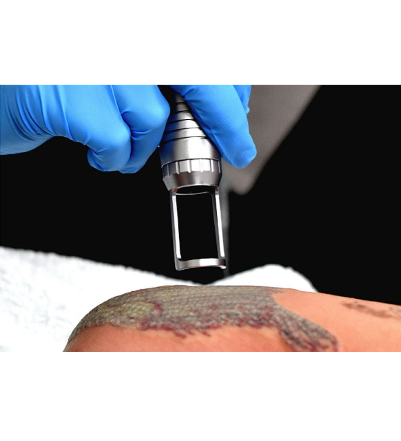 Laser Tattoo Removal