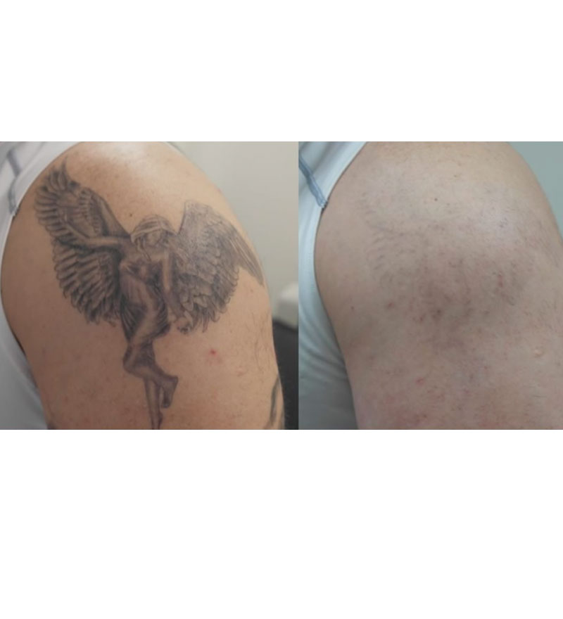 Laser Tattoo Removal