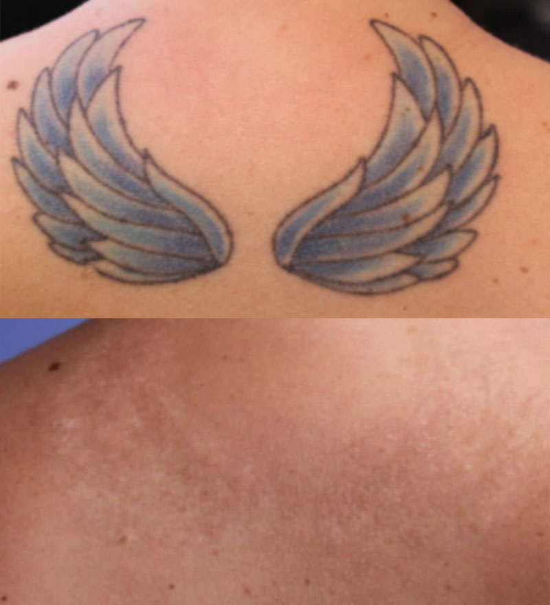 Laser Tattoo Removal