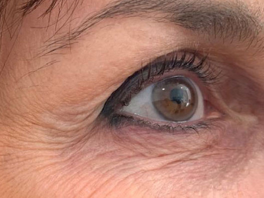 Plasma Lift Resurfacing - Before