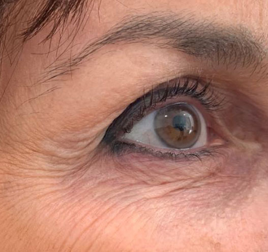 Plasma Lift Resurfacing - Before