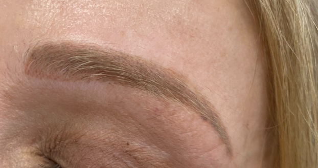 Brow Laser - After