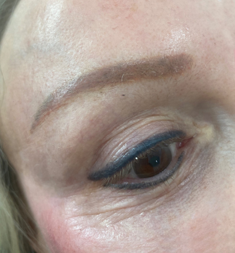 After Brow Laser Removal