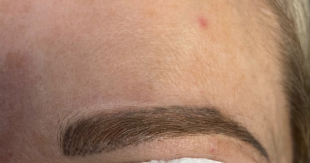 Brow Laser - Before