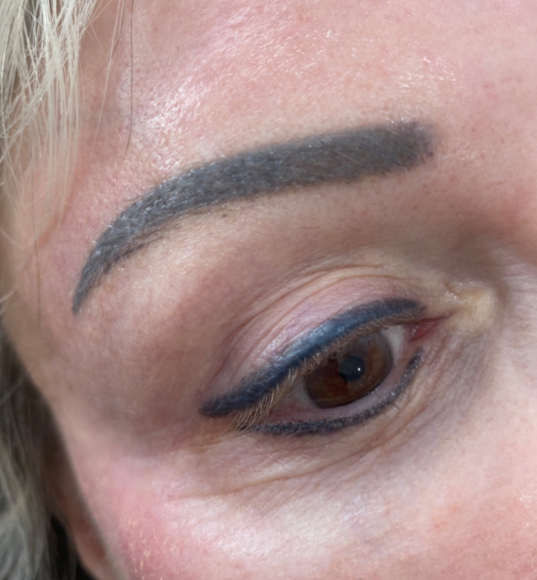 Before Brow Laser Removal